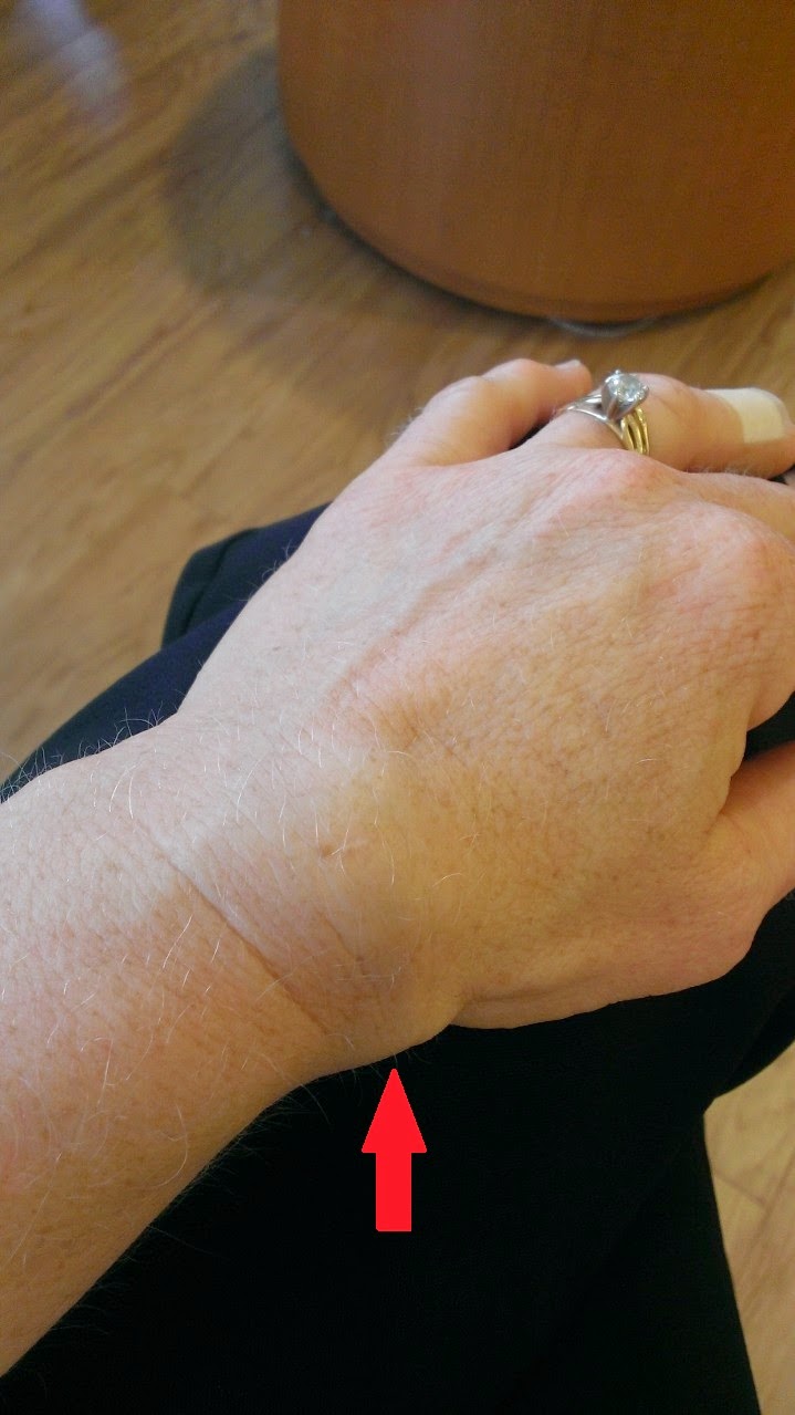 Broken or sprained thumb symptoms Broken or sprained thumb symptoms